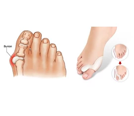 Bütyökkorrigálók