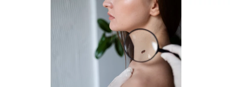 Melanoma: A Sunyító Gyilkos, Amire Figyelni Kell – Tények, Tévhitek és Védekezés