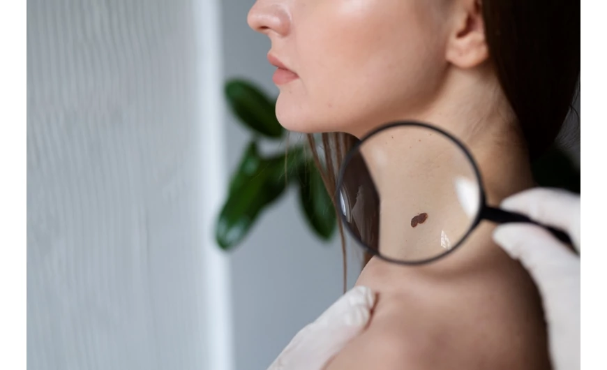 Melanoma: A Sunyító Gyilkos, Amire Figyelni Kell – Tények, Tévhitek és Védekezés